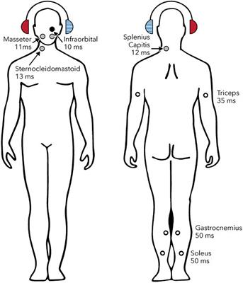 Weak Vestibular Response in Persistent Developmental Stuttering